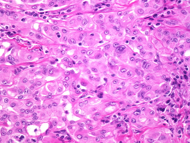 Adenomatoid Tumor5.jpg
